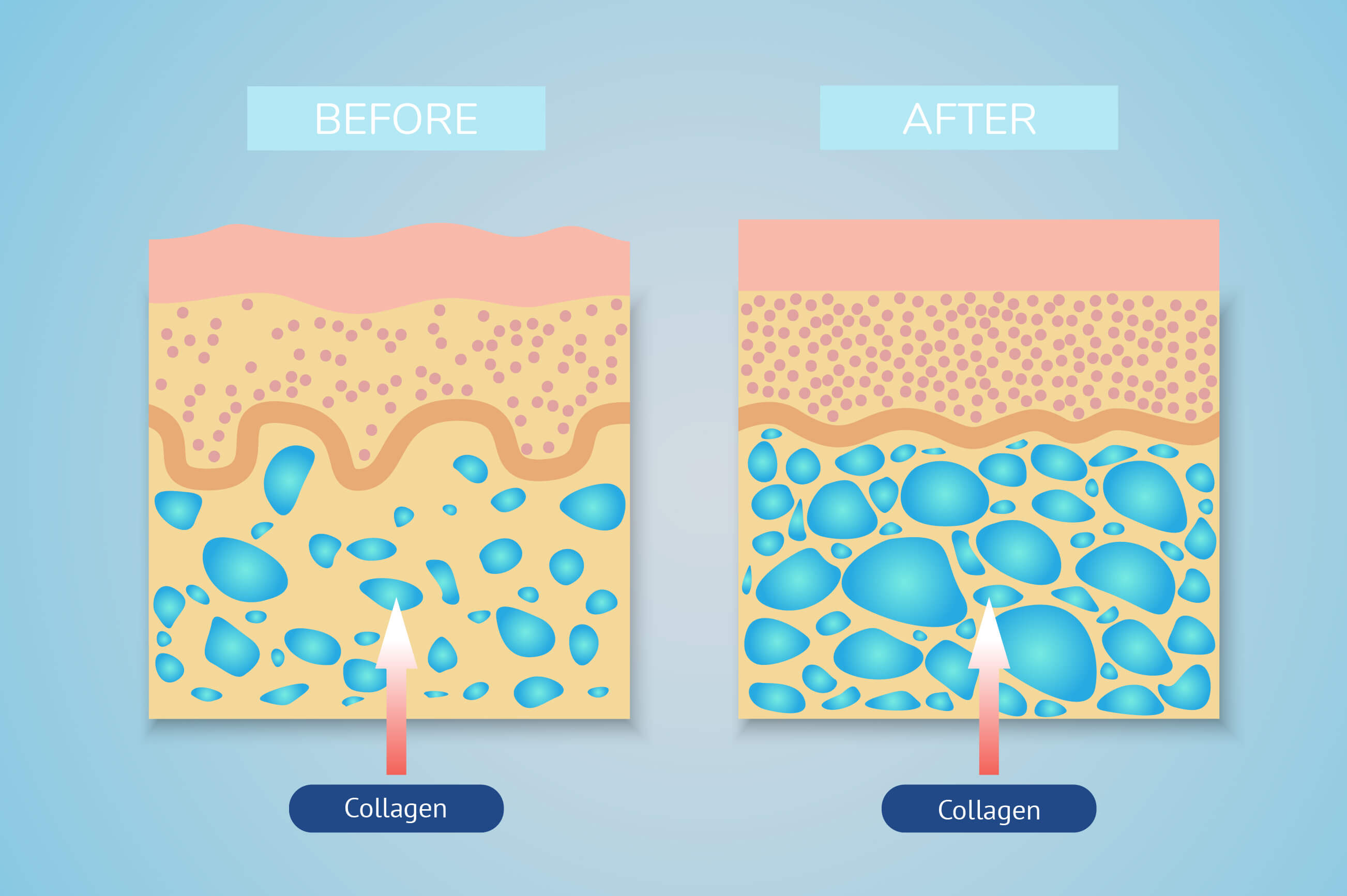 Illustration of the effect of collagen on skin before and after